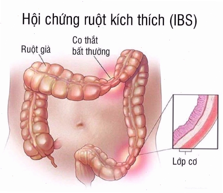 Hội chứng ruột kích thích (IBS) với triệu chứng đau bụng kèm tiêu chảy hoặc táo bón