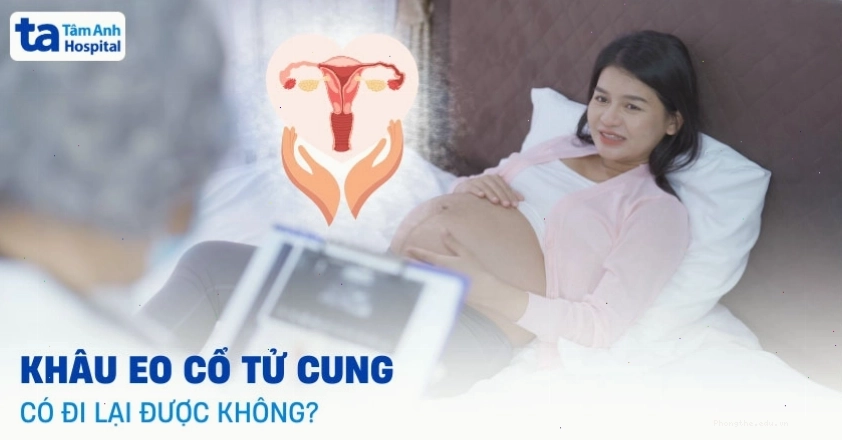 Khâu eo cổ tử cung có đi lại được không