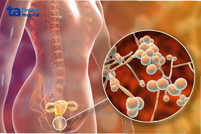 Khí hư lợn cợn như bã đậu