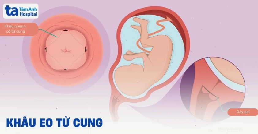 Kỹ thuật khâu eo tử cung