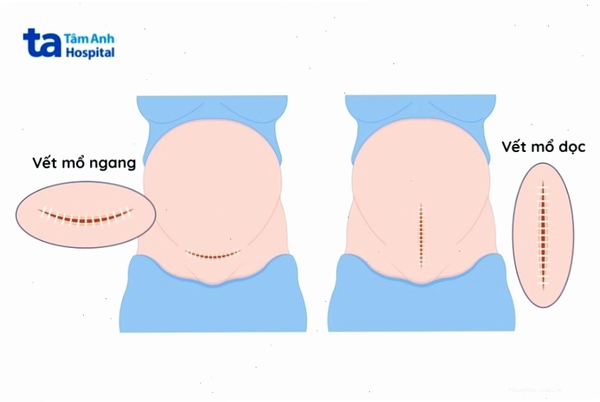Kỹ thuật mổ và loại chỉ khâu ảnh hưởng đến vết mổ sau sinh bao lâu thì lành