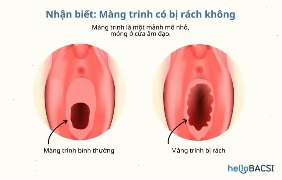 Màng trinh giúp hạn chế bụi bẩn xâm nhập vào vùng kín