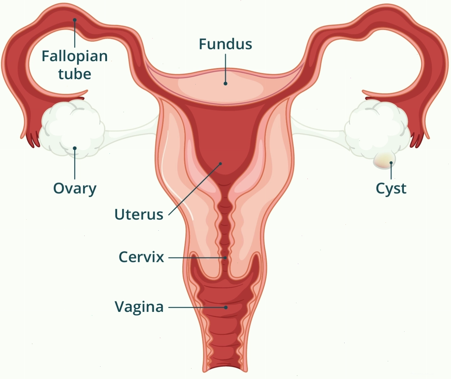 Minh họa hệ thống sinh sản nữ với u nang hình thành trên buồng trứng