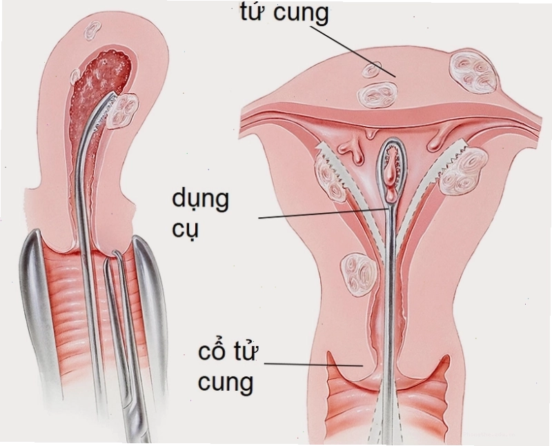 Nạo hút giúp loại bỏ thai trứng khỏi tử cung