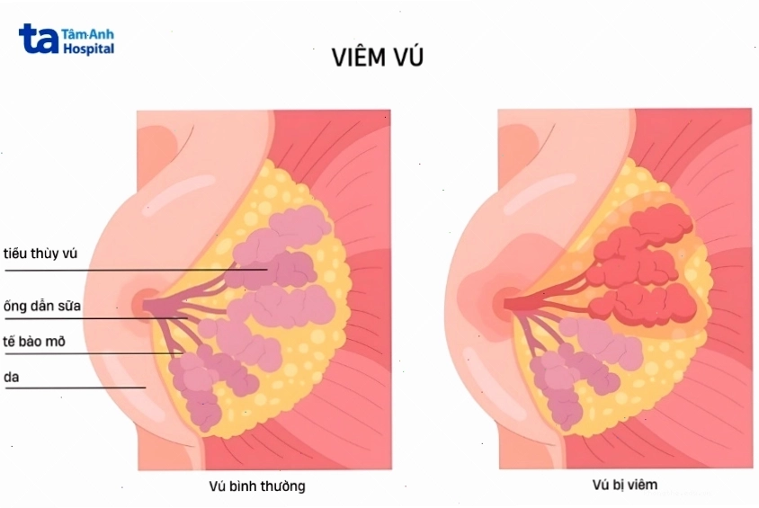 Ngực ấn vào bị đau