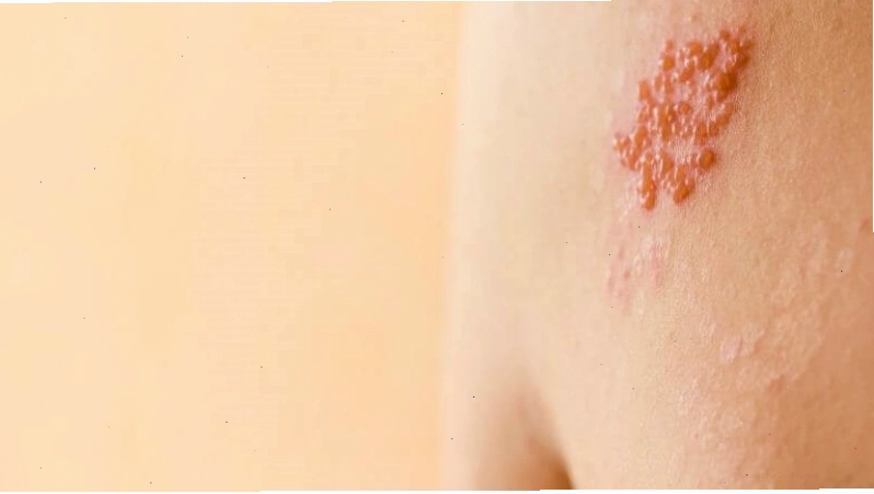 Nguy cơ mắc bệnh Herpes khi quan hệ không an toàn