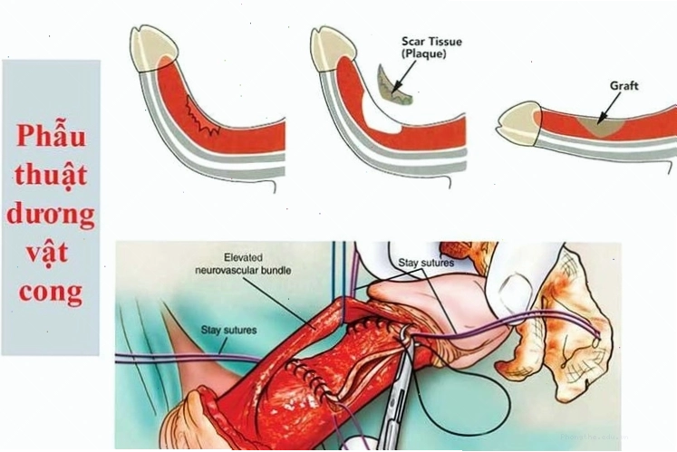 Phẫu thuật điều trị dương vật bị cong