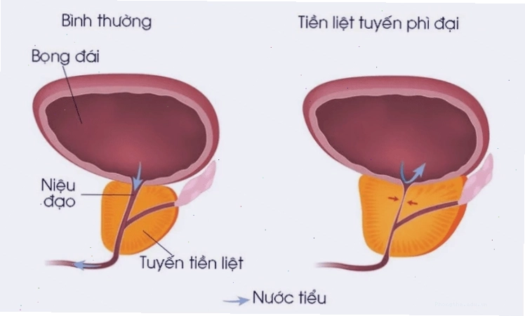 Phì đại tuyến tiền liệt là nguyên nhân phổ biến gây khó đi tiểu ở nam giới