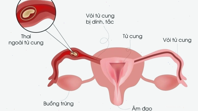Phụ nữ kiểm tra lịch kinh nguyệt trên điện thoại