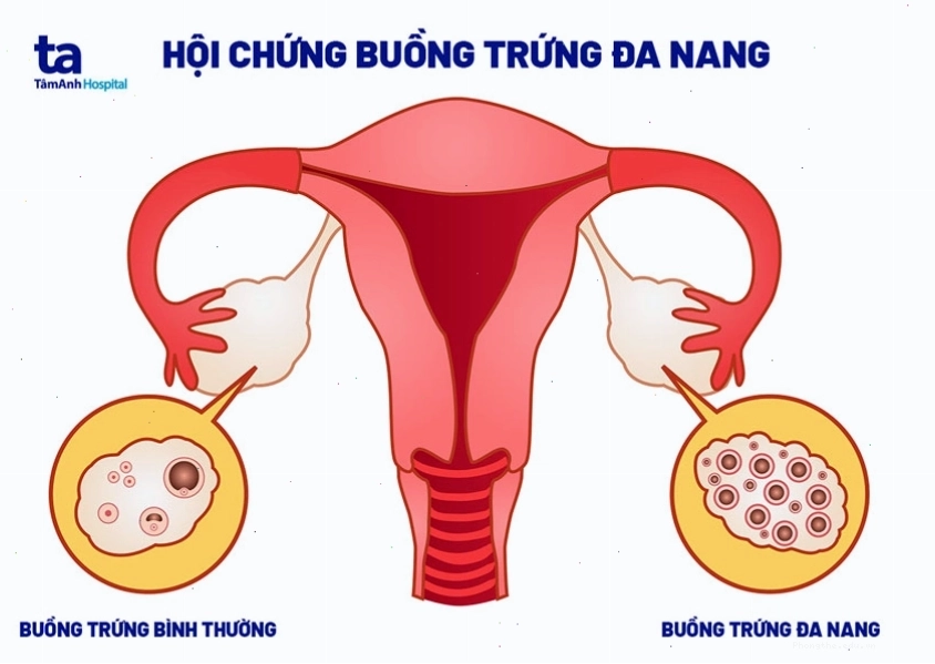 Phụ nữ mắc hội chứng buồng trứng đa nang thường bị chậm kinh kéo dài