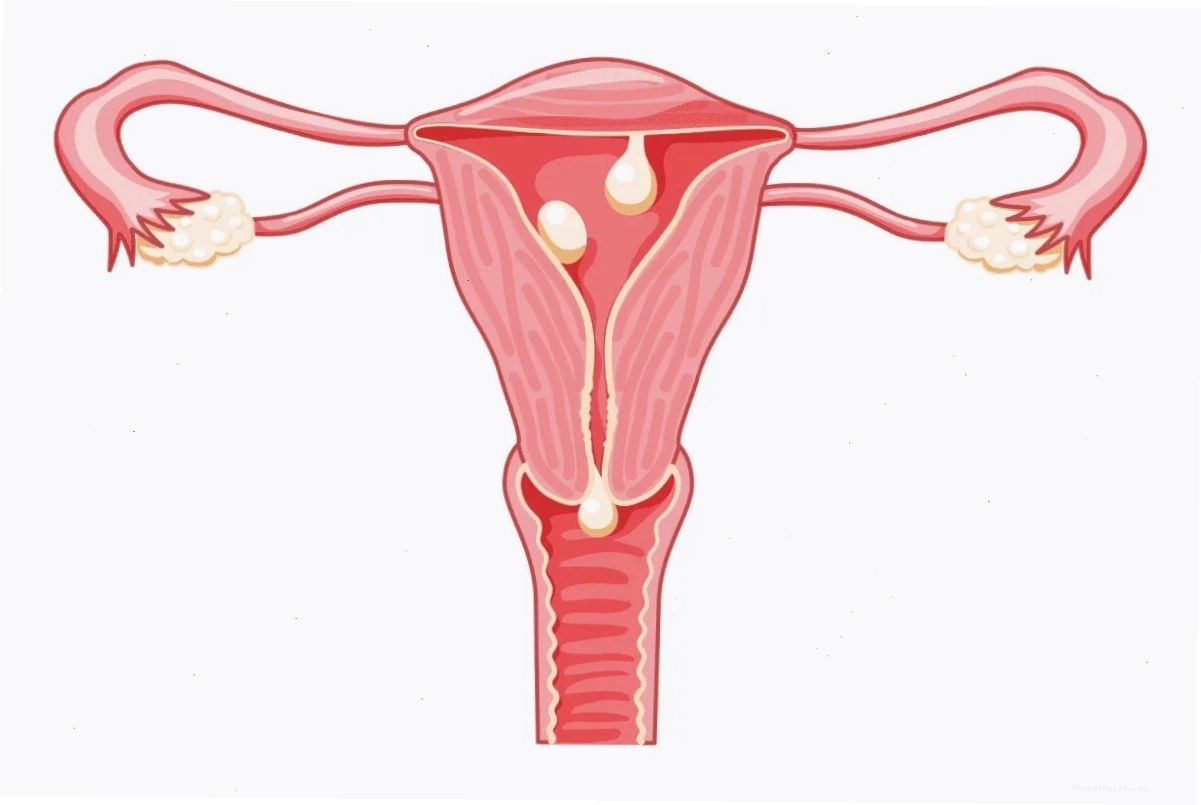 Phụ nữ sau quan hệ ra máu có phải mang thai không? Do polyp tử cung