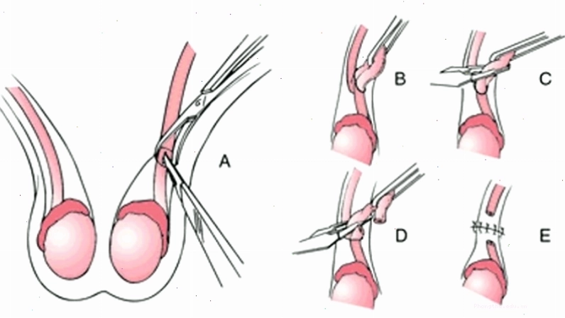 Phương pháp thắt ống dẫn tinh