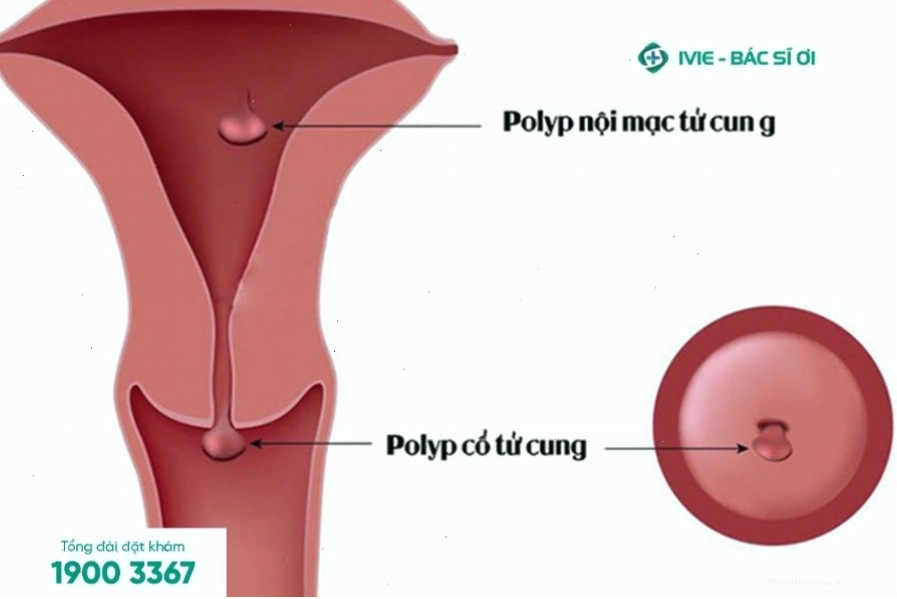 Polyp cổ tử cung gây chảy máu sau quan hệ