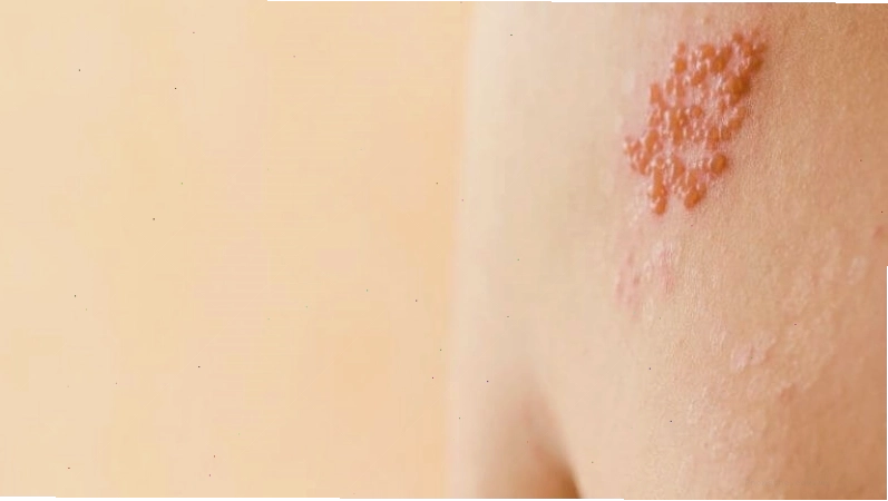 Quan hệ không an toàn có nguy cơ mắc bệnh Herpes
