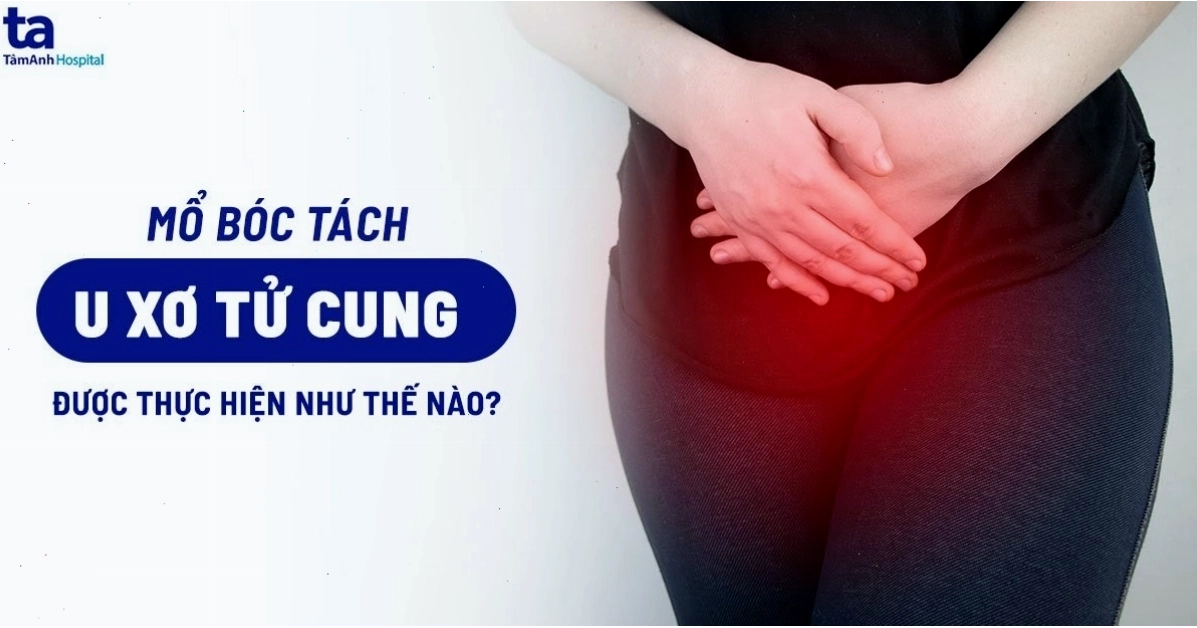 Quy trình mổ bóc tách u xơ tử cung bằng phương pháp nội soi