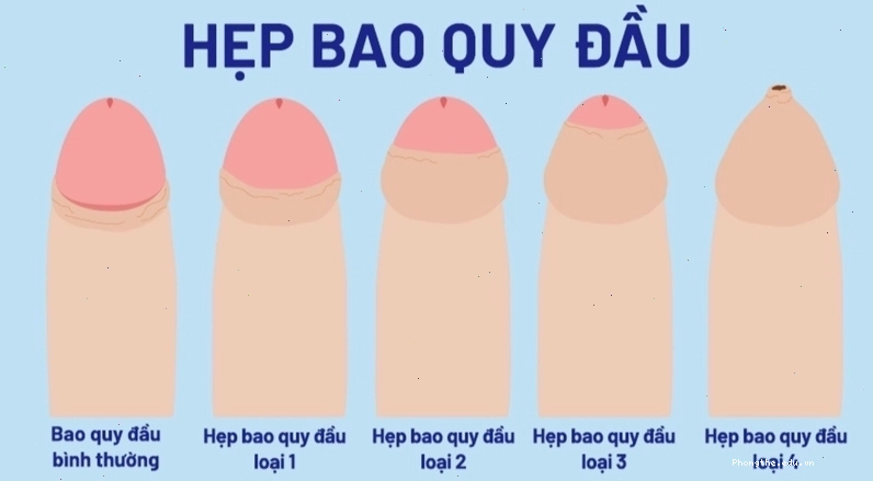 Quy trình phẫu thuật cắt bao quy đầu