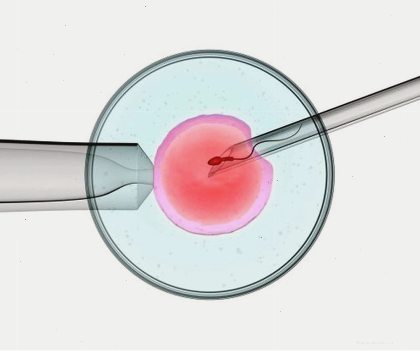 Quy trình sinh con bằng biện pháp ICSI là gì? ICSI (Intra-Cytoplasmic Sperm Injection) là tiêm tinh trùng vào bào tương trứng. Kỹ thuật này