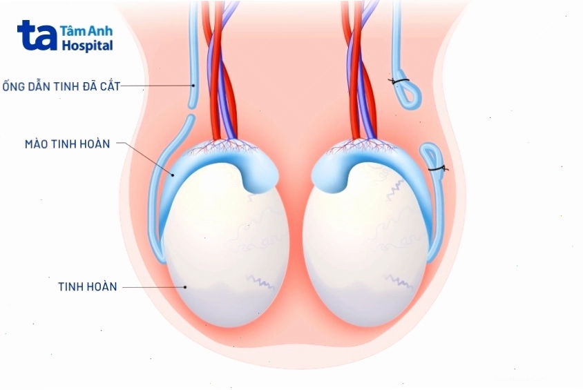 Quy trình triệt sản nam bao gồm việc cắt và thắt ống dẫn tinh