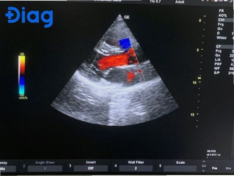 Siêu âm Doppler màu là kỹ thuật bổ sung trong siêu âm qua trực tràng
