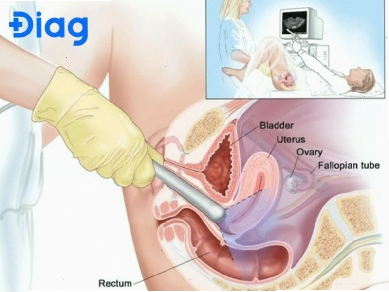 Siêu âm qua đường trực trang giúp đánh giá chi tiết tuyến tiền liệt