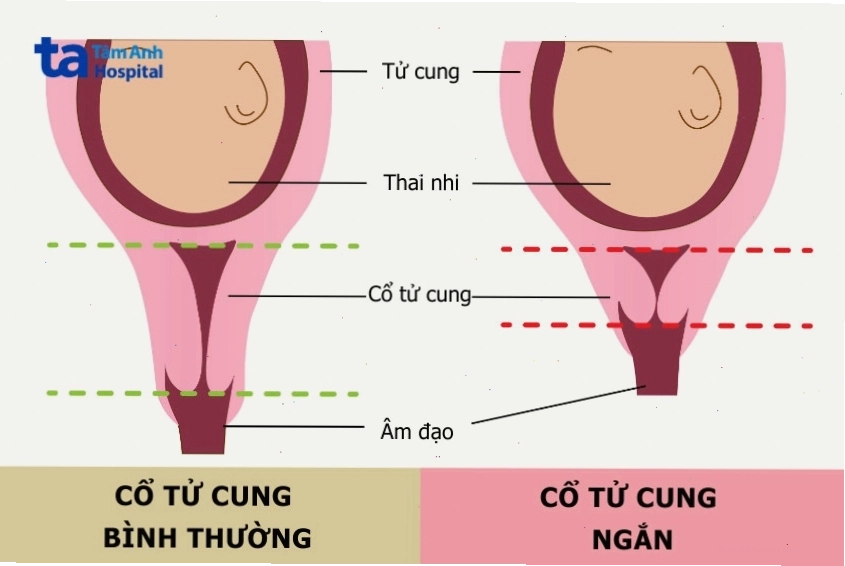 So sánh cổ tử cung bình thường và cổ tử cung ngắn