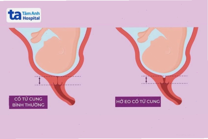 So sánh eo tử cung bình thường và eo tử cung bị hở