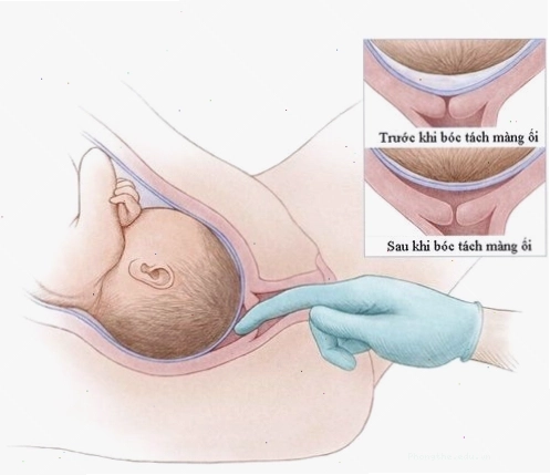 Tách màng ối nhân tạo để kích thích chuyển dạ