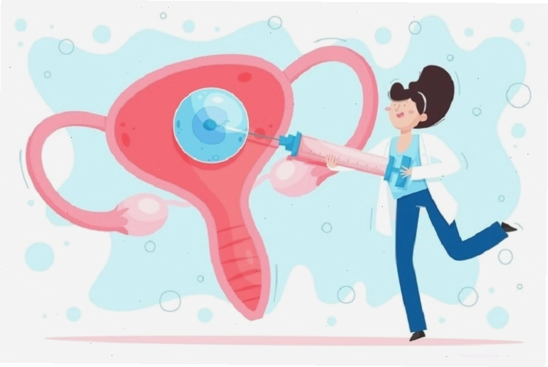 Trong thụ tinh nhân tạo IUI, tinh trùng được bơm vào tử cung