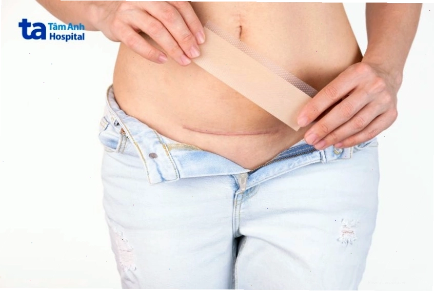 Tư vấn bác sĩ về cách làm mờ sẹo mổ sau sinh