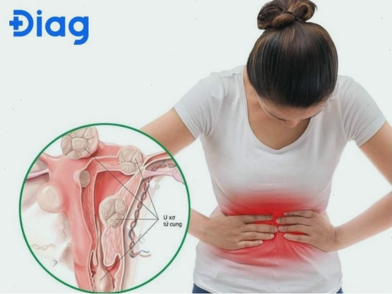 U xơ tử cung gây chảy máu nhiều, kéo dài và xuất hiện ngoài kỳ kinh