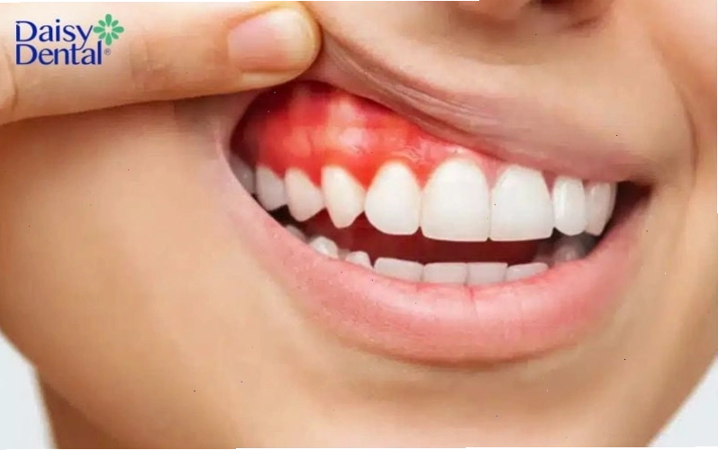 Vệ sinh răng miệng kém là một trong những nguyên nhân hàng đầu khiến bà bầu bị chua miệng