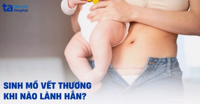 Vết mổ sau sinh bao lâu thì lành, các giai đoạn phục hồi