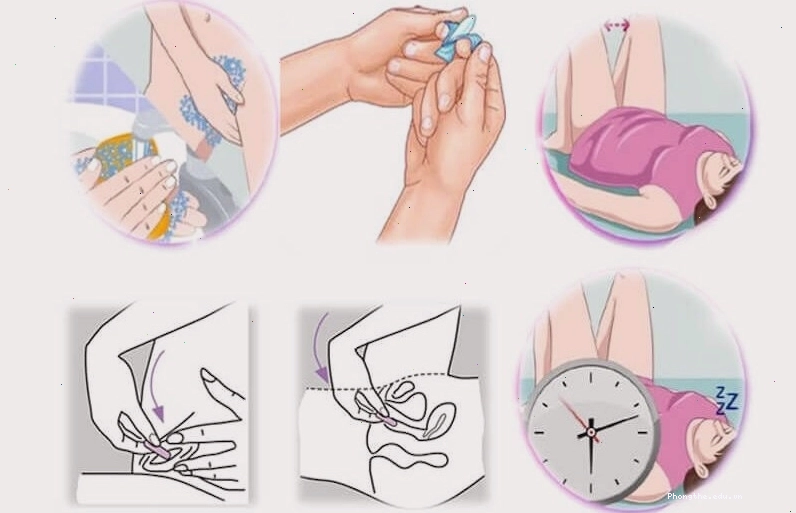 Việc đặt thuốc phụ khoa cần tuân thủ đúng chỉ định của bác sĩ