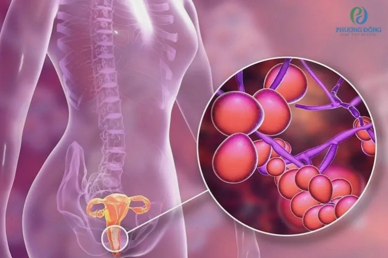 Viêm âm đạo có thể gây ra dịch màu hồng