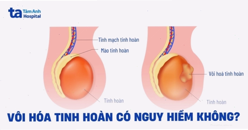 Vôi hóa tinh hoàn có nguy hiểm không? Chữa trị thế nào?