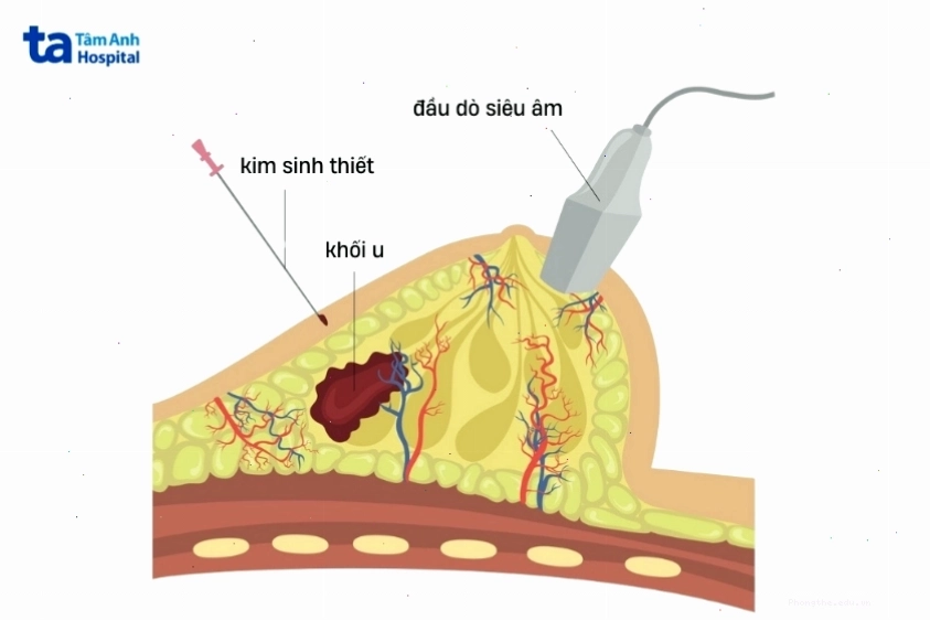 Vú bị đau khi ấn vào