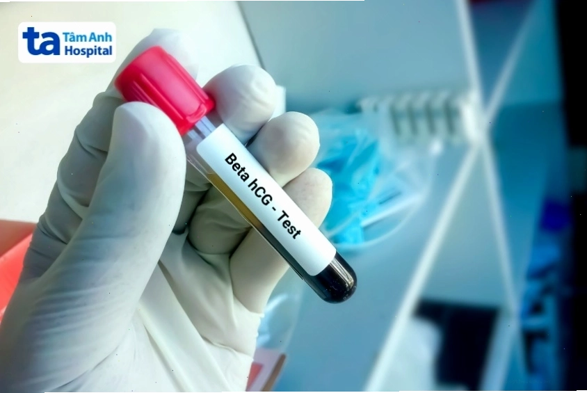 Xét nghiệm Beta-hCG là phương pháp quan trọng để chẩn đoán thai sinh hóa