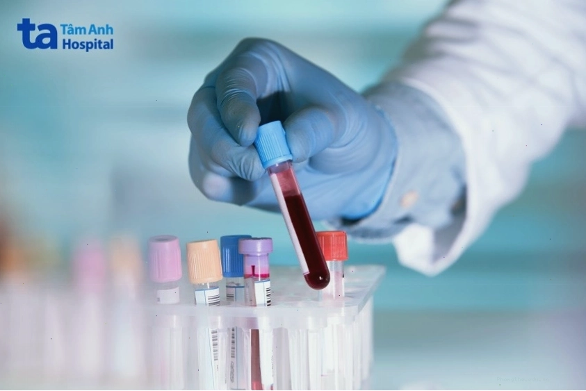 Xét nghiệm máu giúp chẩn đoán nguyên nhân gây nổi hạch vùng bẹn
