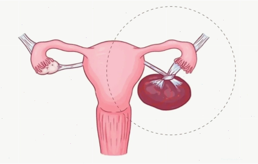 Xoắn buồng trứng là biến chứng thường gặp khi nang xuất huyết có kích thước lớn