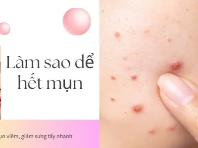 Làm sao để hết mụn viêm, giảm sưng tấy nhanh chóng nhất
