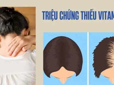 Dấu hiệu thiếu vitamin D và cách bổ sung hiệu quả cho cơ thể