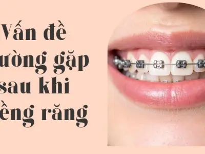 Vấn đề thường gặp sau khi niềng răng theo từng giai đoạn