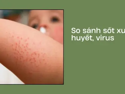 Trải nghiệm vượt qua sốt xuất huyết và dấu hiệu nguy kịch