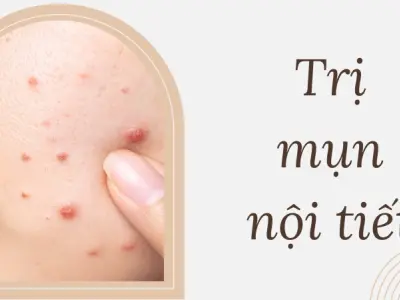 Trị mụn nội tiết dứt điểm hiệu quả chỉ sau 30 ngày