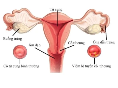 Cổ tử cung cao hay thấp: Cách nhận biết và ảnh hưởng đến khả năng mang thai