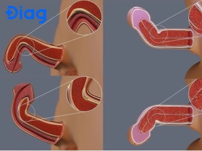 Dương vật bị cong có quan hệ được không? Ảnh hưởng và cách xử lý