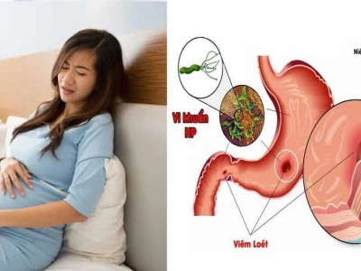 Giảm Đau Dạ Dày Khi Mang Thai An Toàn Cho Mẹ Bầu