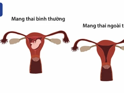Thai ngoài tử cung: Nhận biết sớm các dấu hiệu mang thai ngoài tử cung