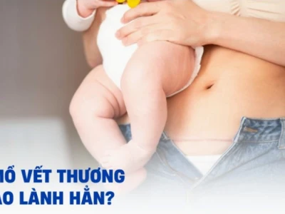 Vết mổ sau sinh bao lâu thì lành? Các yếu tố ảnh hưởng và cách chăm sóc